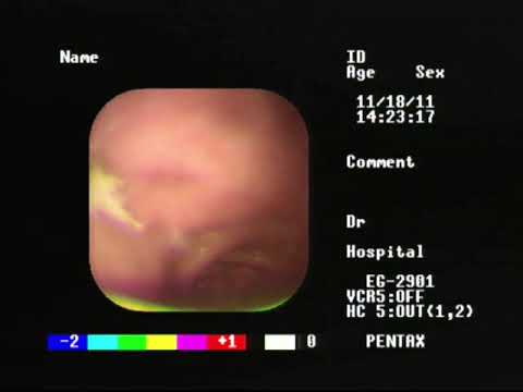 Видео: Павел Пульняшенко: мегаэзофагус