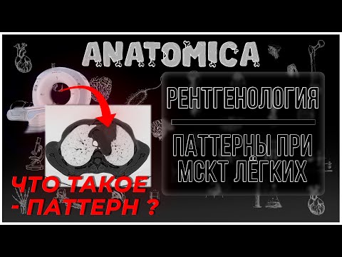 Видео: Что такое МАТОВОЕ СТЕКЛО и АЛЬВЕОЛЯРНАЯ КОНСОЛИДАЦИЯ легких при КТ ? / Рентгенология