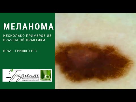 Видео: КАК ВЫГЛЯДИТ МЕЛАНОМА? Случаи из врачебной практики определения меланомы кожи.