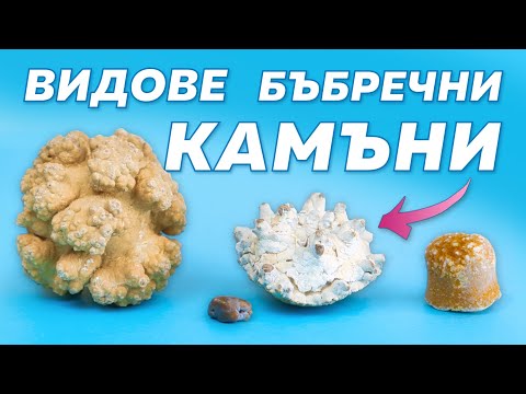 Видео: Кои са най-честите видове камъни в бъбреците?