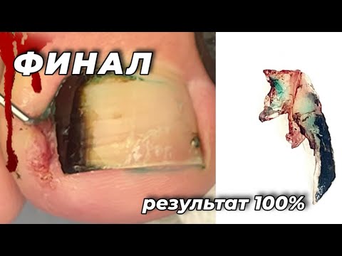Видео: Работа на 1 млн #вросшиеногти 
