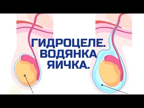 Видео: ГИДРОЦЕЛЕ. ВОДЯНКА ЯИЧКА. ПОЧЕМУ ВОЗНИКАЕТ. ЧТО ДЕЛАТЬ.