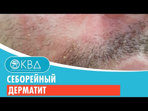 Видео: 😐 Себорейный дерматит. Клинический случай №201