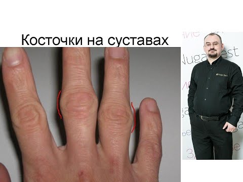 Видео: Костные наросты на суставах