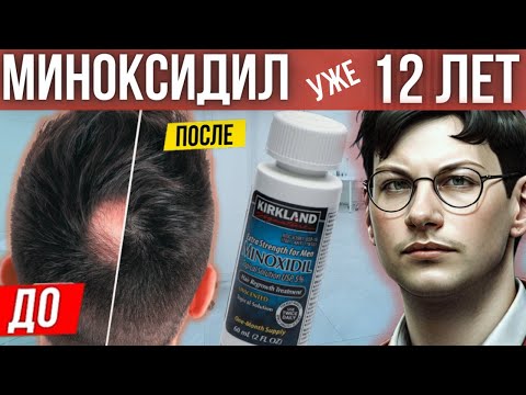Видео: Еще помогает? | Миноксидил для волос | 12 лет использования миноксидила