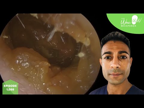 Видео: 1088 — 10 лет удаления ушной серы