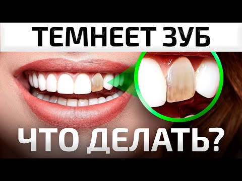Видео: Что, если ЗУБ потемнел! ПОСЛЕДСТВИЯ удаления зубного нерва