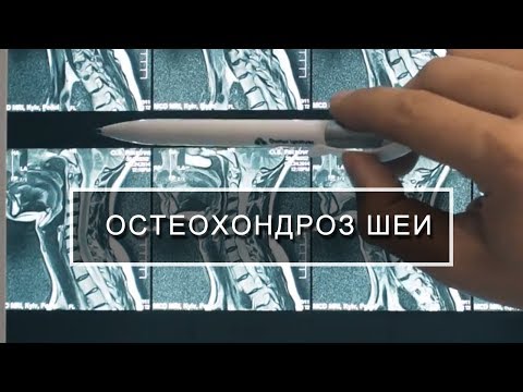 Видео: Шейный остеохондроз, лечение остеохондроза шейного отдела позвоночника.