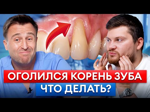 Видео: Что делать, если шейка зуба ОГОЛИЛАСЬ? 8 факторов рецессии десны