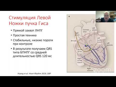 Видео: Основы физиологической стимуляции Сердца. ЭКГ при стимуляции пучка Гиса и области ЛНПГ
