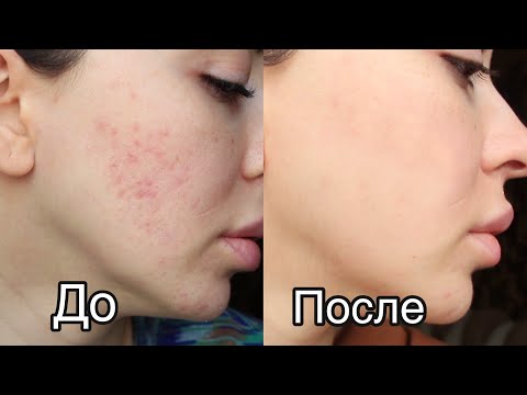Видео: НЕ ПРИНИМАЙ РОАККУТАН, НЕ ПОСМОТРЕВ ЭТО ВИДЕО / ЛЕЧЕНИЕ АКНЕ / Ayka Emilly