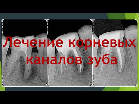 Видео: Секреты Стоматологии - Глава 3. Лечение Каналов