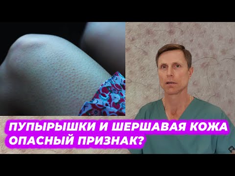 Видео: Пупырышки и шершавая кожа  - опасный признак?