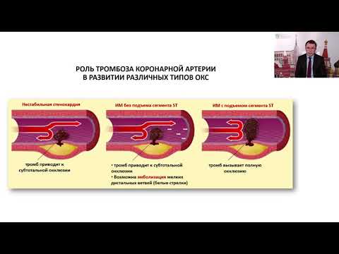 Видео: Инфаркт миокарда ранняя кардиореабилитация