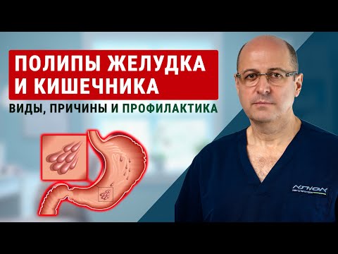 Видео: Полипы желудка и кишечника: виды, причины и профилактика | доктор Юрий Гольдес