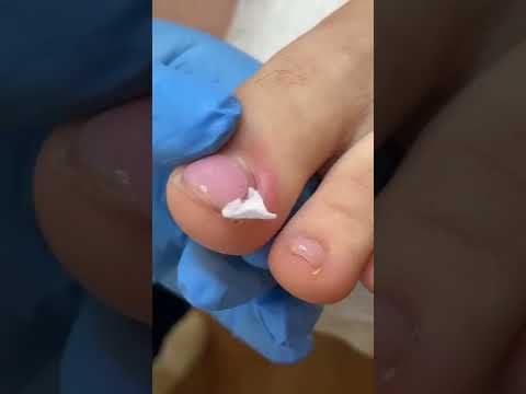 Видео: 003 2 Валеева про вросший ноготь