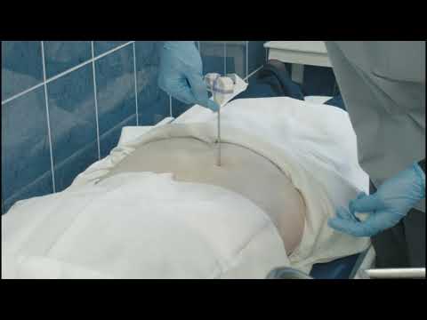 Видео: Трепанобиопсия костного мозга.  Техника манипуляции.