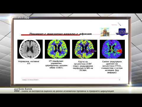 Видео: ИМИ - скала за експресна оценка на ранни исхемични промени в предната циркулация