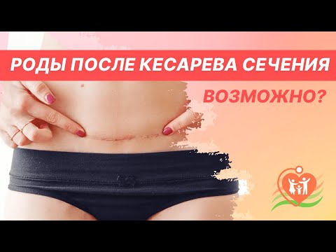 Видео: 🤰 Естественные роды после кесарева сечения. Рубец на матке - возможны ли роды после кесарева?