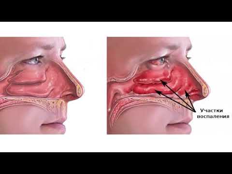 Видео: Заложенность носа хронически. ВАЗОТОМИЯ.