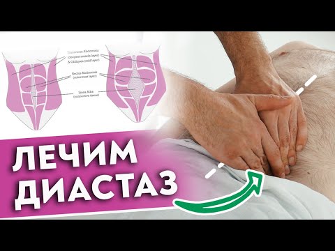 Видео: Проблемы «белой линии» живота / Как вылечить диастаз при помощи массажа?