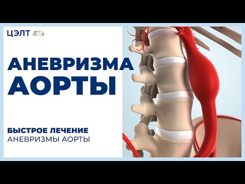 Видео: Аневризма аорты. 🛏 Быстрое лечение аневризмы аорты. ЦЭЛТ