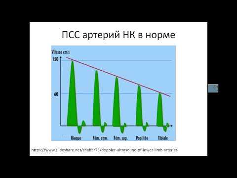 Видео: УЗДГ артерий НК.  Часть 1.  Характеристика допплеровского спектра артерий нижней конечности.
