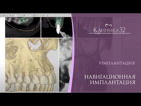 Видео: 💻 Навигационная имплантация. Хирургия по шаблонам