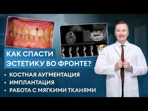 Видео: КАК СПАСТИ ЭСТЕТИКУ во фронте? Когда ПЕРЕГОРОДКА УШЛА, а кость наполовину ПОТЕРЯНА? Разбор кейса