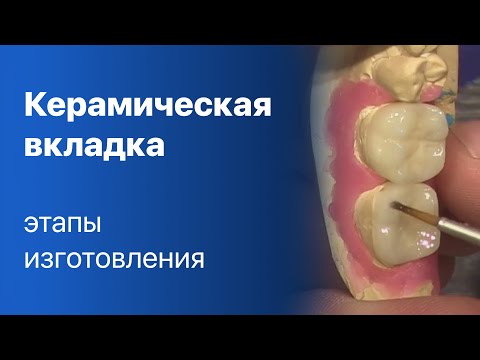 Видео: Керамическая вкладка | Изготовление | Этапы