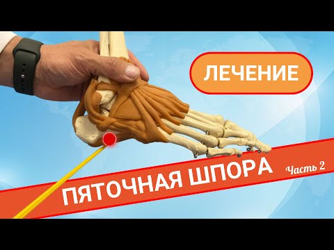 Видео: КАК ЛЕЧИТЬ ПЯТОЧНУЮ ШПОРУ? (Часть 2)