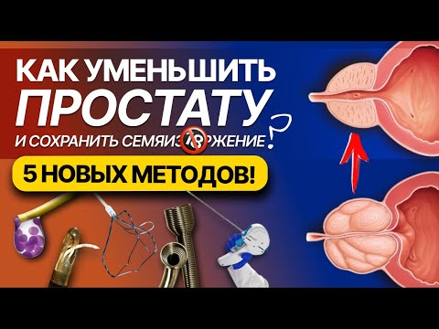 Видео: Аденома простаты, новые способы уменьшения железы. Обзор недостатков и преимуществ всех методов