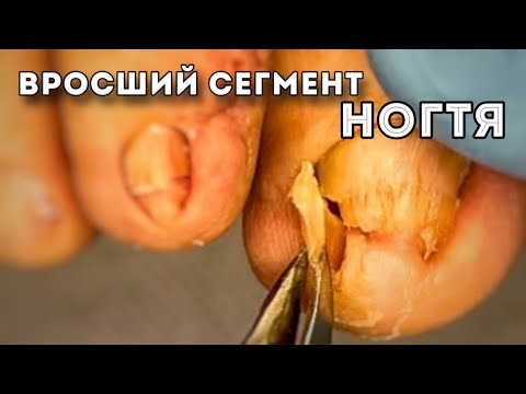 Видео: Коррекция вросшего ногтя у #подологтатьянапак