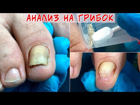 Видео: Грибок ногтей 🍄 Как правильно собрать материал на анализ