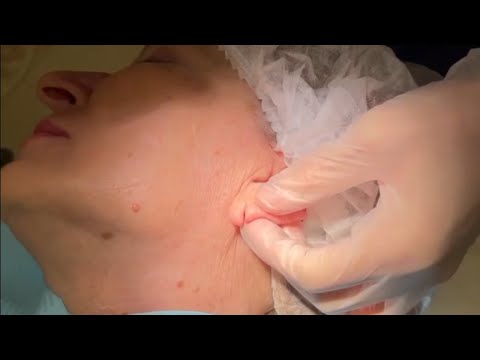 Видео: Ушивание мочки уха после сережек, тоннелей