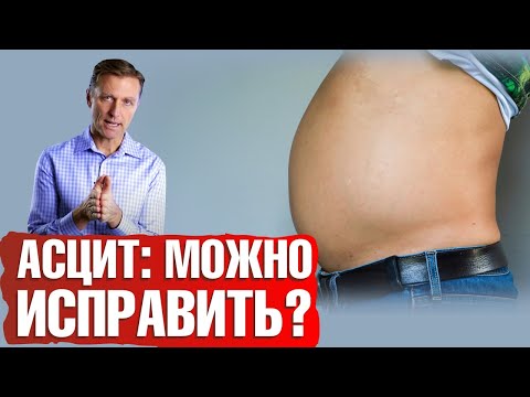 Видео: Асцит печени👉Причины асцита и симптомы асцита. Как лечить асцит