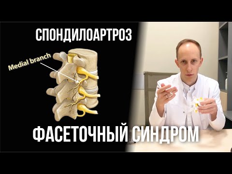 Видео: Спондилоартроз | Фасеточный болевой синдром | Блокада и денервация межпозвонковых суставов