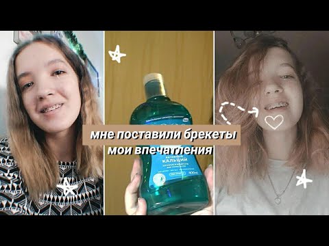 Видео: МНЕ ПОСТАВИЛИ БРЕКЕТЫ | Первые Ощущения | Get My Braces | Больно ли ставить брекеты??