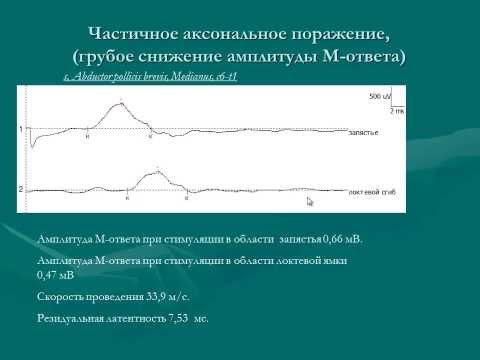 Видео: Травмы нервов и электромиография