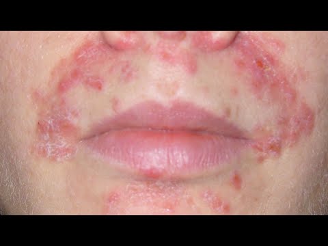 Видео: ПЕРИОРАЛЬНЫЙ ДЕРМАТИТ
