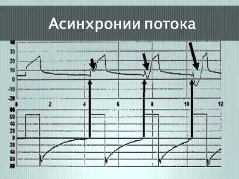 Видео: Синхронизация в ИВЛ (2 МСН) Полупан А.А.