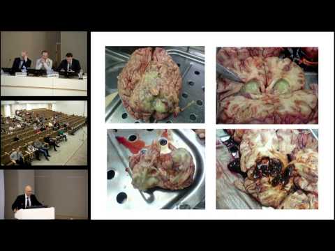 Видео: Нозокомиальный менингит в нейрохирургической клинике  Савин И.А.  22.04.17