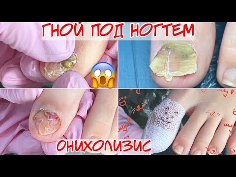 Видео: Гной под ногтем 😱 онихолизис и травма , что делать? 🤕
