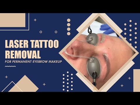 Видео: Лазерное удаление татуажа для перманентного макияжа бровей | Беверли-Хиллз, Калифорния | Доктор Д...