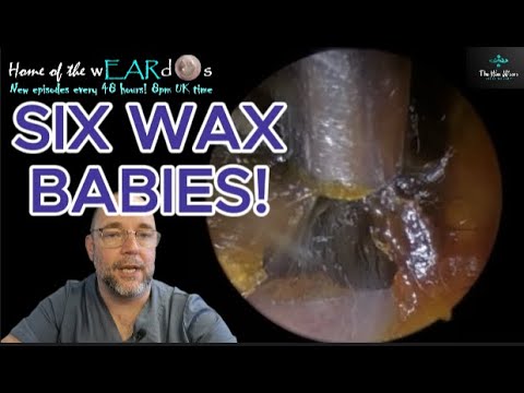 Видео: ШЕСТЬ ДЕТЕЙ ИЗ ВОСК! 263 #ухо #ушнаясера #удалениеушнойсеры #чисткаушей #fyp #asmr #asmrearwax #у...