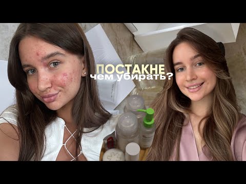 Видео: МЕТОДЫ БОРЬБЫ С ПОСТАКНЕ | ПОДРОБНО О КАЖДОМ 