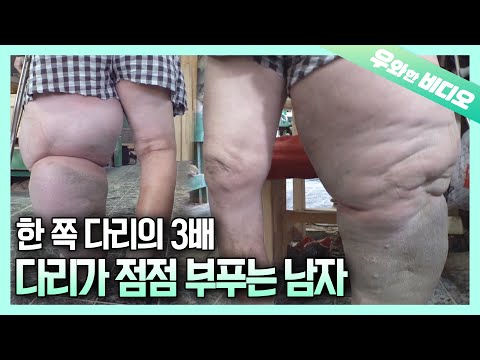 Видео: Как человек с распухшей ногой мог сохранять мотивацию в течение 19 лет