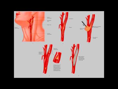 Видео: Vascular suture #4 Patch operation. Ставим заплату на сосуд! 1080р! (: