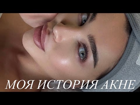 Видео: Как я избавилась от акне | Роаккутан | Рецидив | Альтернативное лечение | Салонные процедуры | Уход