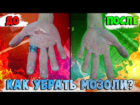Видео: МОЗОЛИ от ТУРНИКА | КАК УБРАТЬ? | КАК БОРОТЬСЯ С МОЗОЛЯМИ? | Я СОРВАЛ МОЗОЛЬ, ЧТО ДЕЛАТЬ?